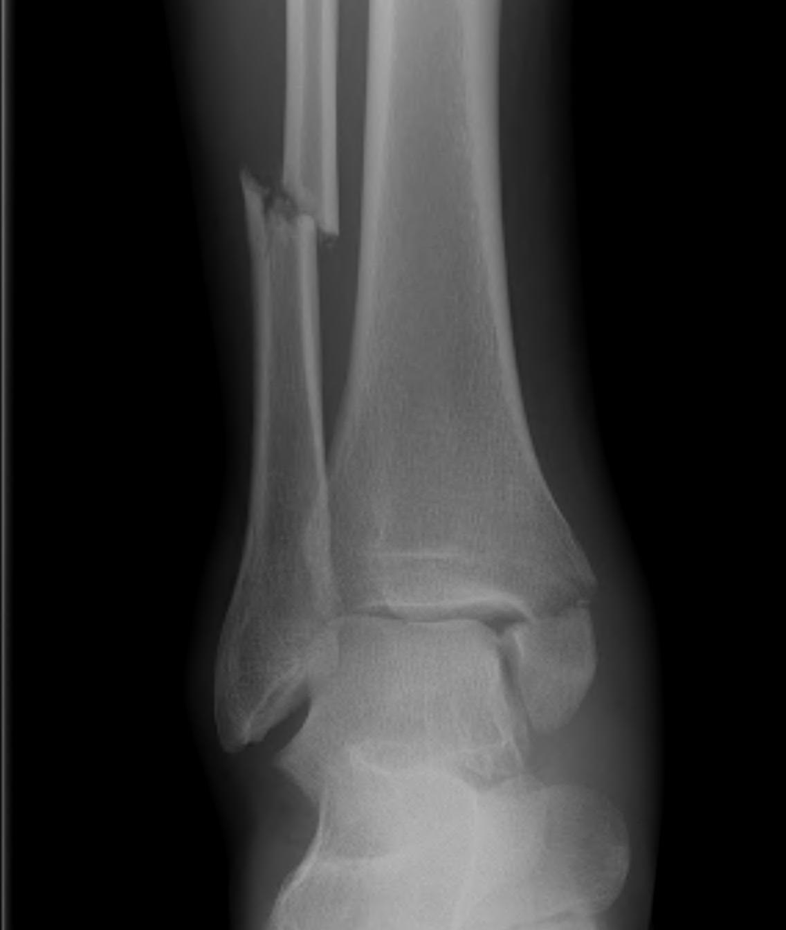 Ankle Fracture Bimalleolar